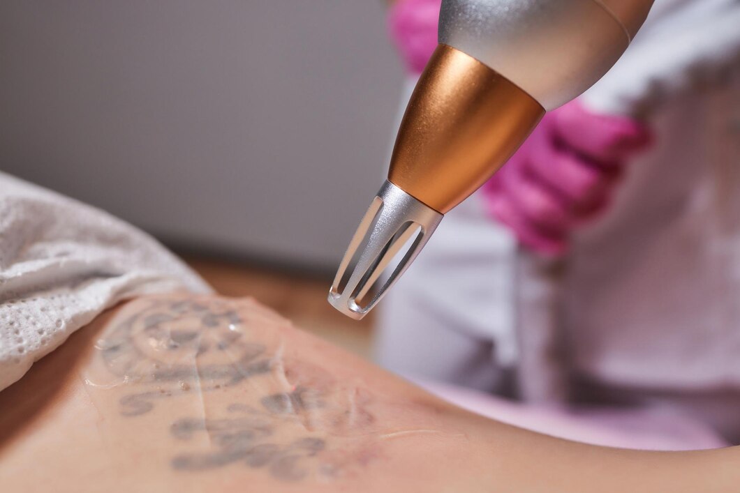 Laser Treatments